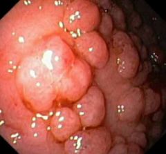 1. Colon cancer


2. Adenomatous hyperplastic polyps


<---


3. Diverticula of the colon


4. Inflammatory conditions of the colon/rectum (crohn's, ulcerative colitis, etc.)


5. Ischemic colitis


6. Hemorrhoids


7. Anal fissures