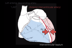 Left anterior descending artery is also known as Anterior interventricular artery