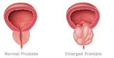 benign prostatic hyperplasia


<---


 


urethral stricture 


 


lesions of the bladder or prostate


 


 