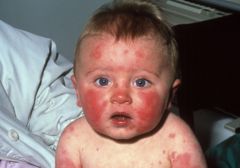 Virus Infections of the Skin: Rashes
Spots, Bumps
Maculo-papular rashes (flat to slightly raised colored bump)