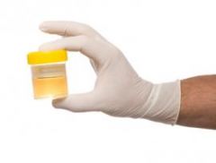There is no presently accepted urine test to detect the use of which of the following performance-enhancing drugs? 1-Ephedrine, 2-Dihydroepiandosterone, 3- Androstenedione; 4-Hum growth hormone; 5- Tetrahydrogestrinone