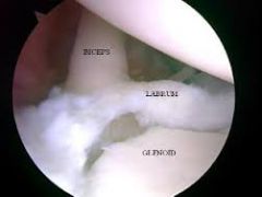 the attachment of the long head of the biceps onto the glenoid has been described as "posterior" or "posterior-dominant" in roughly 70%, 5% the attachment anterior, structural fibers of the long head of the biceps attach directly sup glenoid tuber...