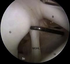Which best describes a Buford complex? 1-nl  variant characterized by a cord-like MGHL & an absent anterosuperior labrum; 2-Nl variant characterized by a cord-like SGHL & absent posterosuperior labrum; 3- Abn arthroscopic finding a cord-like MGHL ...