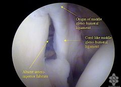 seen in 1.5% of individuals and consists of a cord-like MGHL and absent anterosuperior labrum complex. The cord-like MGHL should NOT be repaired down to the glenoid as this will result in < postop ROM.