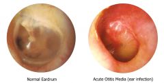 Triad of:
i. otalgia
ii. fever
iii. hearing loss (conductive)
- otorrhea if tm perforated
- rarely tinnitus, vertigo, and/or facial nerve paralysis

infants and toddlers may present w/: 
- ear tugging
- irritability, dec. sleep
- vomitin...
