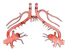 1. The anterior cerebral artery. It arises from either the distal A1 or proximal A2 segment. 

2. It supplies the anteromedial portion of the caudate nucleus, the anterior putamen, and parts of the globus pallidus. It also supplies the inferior ...