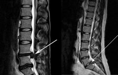 most important next step is identifying a source of compression in the lum spine. The study of choice is an MRI, however in patient who cannot have an MRI-pacemakers, a CT myelogram done, Cauda equina is an ABSOLUTE indication for surgical tx.