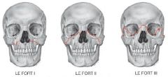 Le Fort fractures:

LE FORT I: isolated dissociation of the alveolar process
LE FORT II: dissociation of the maxilla, possibly also ethmoid and nasal bone
LE FORT III: dissociation of entire viscerocranium from neurocranium
Cause: traffic accidents
