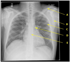 On the A-P chest radiograph, identify the labelled features A-E of the thorax and upper limb.