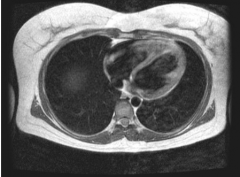 Does the above axial MRI sections through the thorax show contents of the superior or the inferior mediastinum?