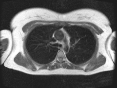 Does the above axial MRI sections through the thorax show contents of the superior or the inferior mediastinum?