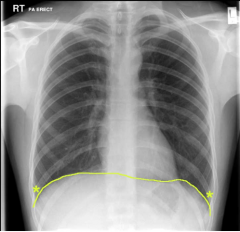 Which one of the following applies to the structure marked with asterisks (*) on the AP chest radiograph above? Note: The diaphragm is marked by the yellow line.

Select one:
A. During expiration, it contains lung tissue. 
B. It extends supero-inferio