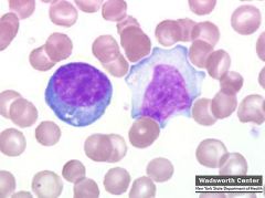 atypical lymphocyte of infectious mononucleosis