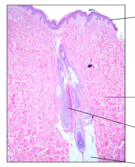 What are the layers and structures and describe what what type of inflammation occurs here?