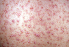 Describe this skin image and what can cause it? Treat?