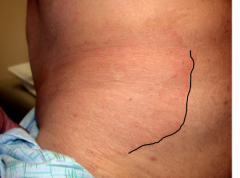 Describe the rash. What do you do to diagnose it? What causes it?