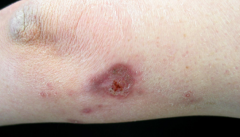 What is this and describe it? and what causes it? Treatment and Dx?