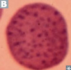 What disease is associated with this type of cell?