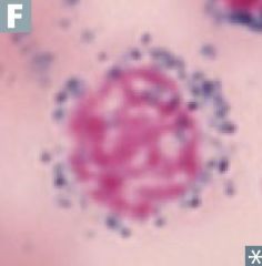 What disease is associated with this type of cell?
