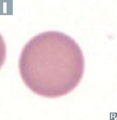 Small, round RBCs with no central pallor