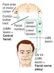 Lesion of motor cortex
Lesion of connection between the cortex and the facial nucleus