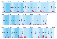 Sequence of sleep stages on three representative nights Columns indicate awake (A) and sleep stages 2, 3, 4, and REM. Deflections in the line at the bottom of each chart indicate shifts in body position. Note that stage 4 sleep occurs mostly in the early 