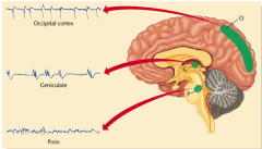 PGO waves
PGO waves start in the pons (P) and then show up in the lateral geniculate (G) and the occipital cortex (O). Each PGO wave is synchronized with an eye movement in REM sleep
