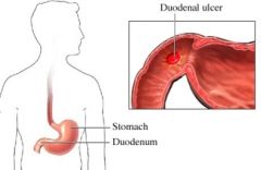 Als een maagband is verbonden met het knooppunt tussen de maag en twaalfvingerige darm, zodat voedsel de maag niet kan verlaten bij een dier, is het dier verzadigd wanneer de maag vol is.