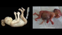 Classic triad:
Renal Cystic Dysplasia
Cephalocele
Polydactyly

Should have 2/3 classic features
