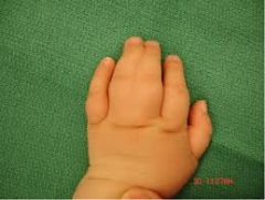 Syndactyly: fused fingers