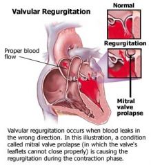 True: valvular incompetence that prevents complete valve closure, allowing blood to flow back up into previous chamber