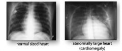 in which cardiac enlargement, valvular calcification and interstitial edema in the lungs can appear