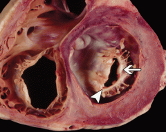 Fibrous thickening of the valve leaflets, fusion of the commissures and leaflets calcification due to inflamation.

Photograph of a short-axis section from the base of the heart of a 44-year-old woman with rheumatic mitral stenosis shows diffuse fibrous