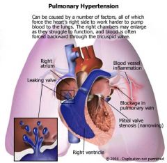 Pulmonary congestion, and after time Pulmonary Arteriolar Hypertension
