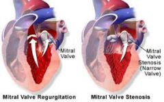 Leaflets of mitral valve do not close properly, back flow of blood into the left atrium.
