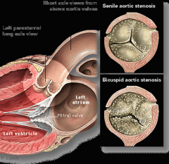 Calcified and harden aortic valve