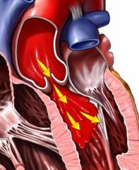 Occurs from abnormalities of the valve leaflets or dilation of the aortic root which stretches leaflets and prevents form closing tightly, creating backflow to Lt ventricle during diastole