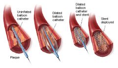 -improves coronary blood flow by enlarging the disease artery's lumen
-pressurized balloon is inflated in the vessel to open obstruction