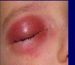 -Infection of deep soft tissues of eye
-Usually staph or strep
-Fever, leukocytosis, proptosis
-Dec EOM
-Afferent pupillary defect
-Tx w/ admission and IV antibiotics