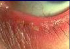 -Inflammation of lid margins w/ greasy flakes on lashes and redness of lid margin
-Irritation, blurring, itching
-May also be due to bacterial invasion (acute) 
-Tx w/ antibiotic eye ointment, eyelid scrubs, warm compresses