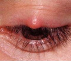 -AKA sty
-Caused by inflamed meibomian gland resulting in pustule
-Position is ON lash margin
-PAINFUL, red
-Tx w/ warm packs, antibiotic eye ointment