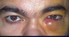 -Infection of lacrimal sac usually due to congenital or acquired obstruction of nasolacrimal system
-Due to staph aureus or hemolytic strep in acute and S epidermdis, anaerobic strep, or Candida albicans in chronic
-Pain, swelling, redness in tear sac a