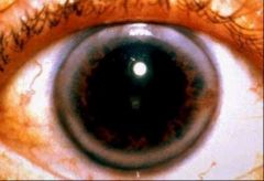 -Hazy ring at edge of cornea where meets iris
-Composed of lipids deposited in periphery of cornea
-Common after 60, lipid disorder before 40