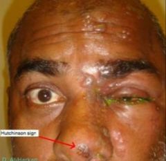 -Occurs when varicella-zoster virus reactivated in ophthalmic division of trigeminal nerve
-Malaise, fever, HA and periorbital burning and itching
-Tip of nose involvement predicts involvement of eye
-Tx w/ high dose acyclovir, valcyclovir w/in 72 hrs 