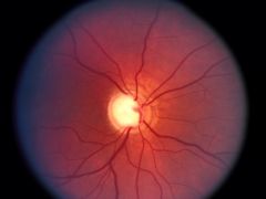 -Third leading cause of blindness
-Optic nerve damage due to increased IOP 
- Pathologic cupping of optic disc 
-Insidious progressive bilateral loss of peripheral vision, resulting in tunnel vision but preserved visual acuities
-Tx w/ prostaglandin a