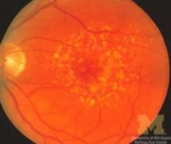 -Small, yellowish deposits that form w/in layers of retina
-Represents breakdown of photoreceptors
-May concentrate at posterior pole between optic disc and macula
-Increase in size or number raises risk of developing AMD