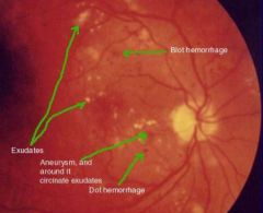 -Microaneurysms, hemorrhages, exudates, and edema of retina
-Types include background, maculopathy, proliferative
-Tx w/ lasers to block development of new vessels and stop leaking vessels 
-Tight glucose control is best