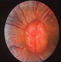 -Condition in which increased pressure in or around brain causes optic nerve to swell where enters eye
-Disc is swollen and margins blurred
-Caused by brain tumor or abscess, head injury, bleeding in brain, severe HTN, infection of brain