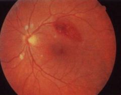 -White or grayish, ovoid lesions w/ irregular "soft" borders
-Moderate in size but usually smaller than disc
-Result from infarcted nerve fibers
-Seen in HTN, DM, AIDS
