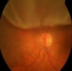 -Separation of light-sensitive membrane in back of eye (retina) from supporting layers
-PAINLESS, sudden loss of vision
-Flashing lights and new floaters may be sign of impending detachment
